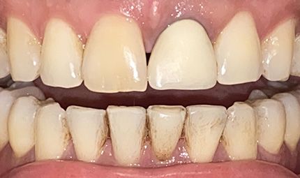 Before Clear Aligner Therapy Case 006