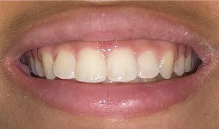 After Composite Bonding Case 007
