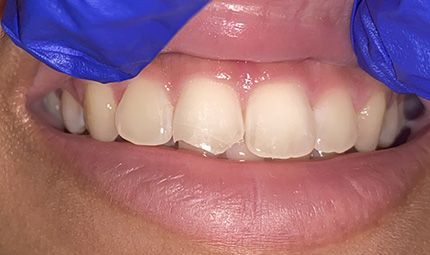 Before Composite Bonding Case 007