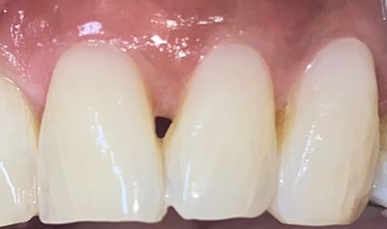 After Composite Bonding Case 009
