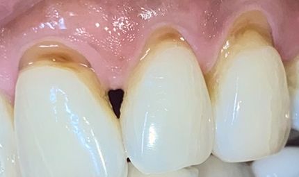 Before Composite Bonding Case 009