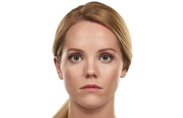 juvederm