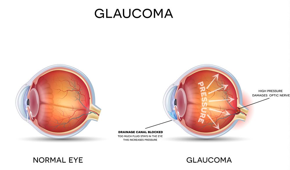 Glaucoma Management