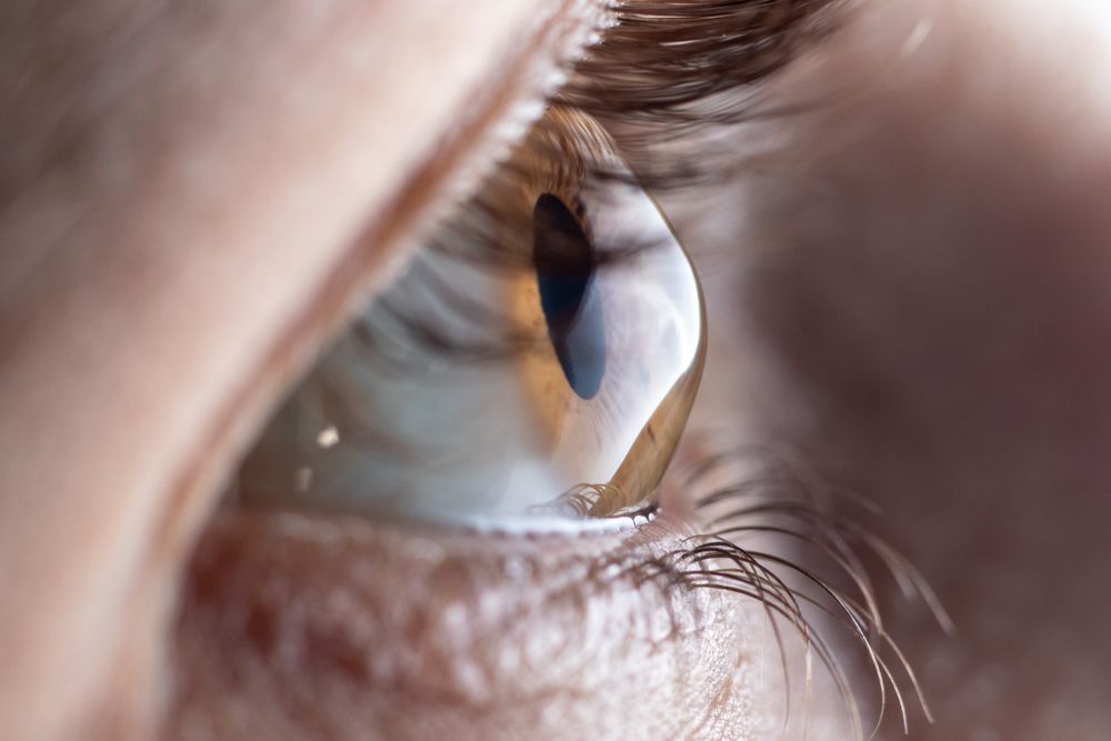 Keratoconus: Causes, Symptoms, and Treatment Options