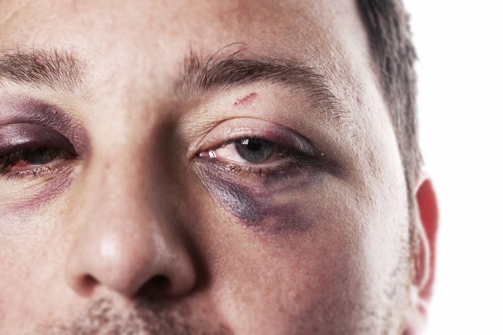 A Comprehensive Guide to Understanding and Treating Black Eyes