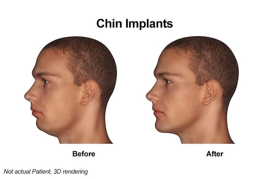 chin implants