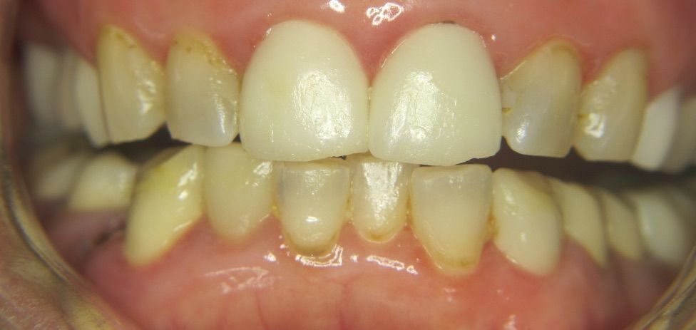 after composite bonding