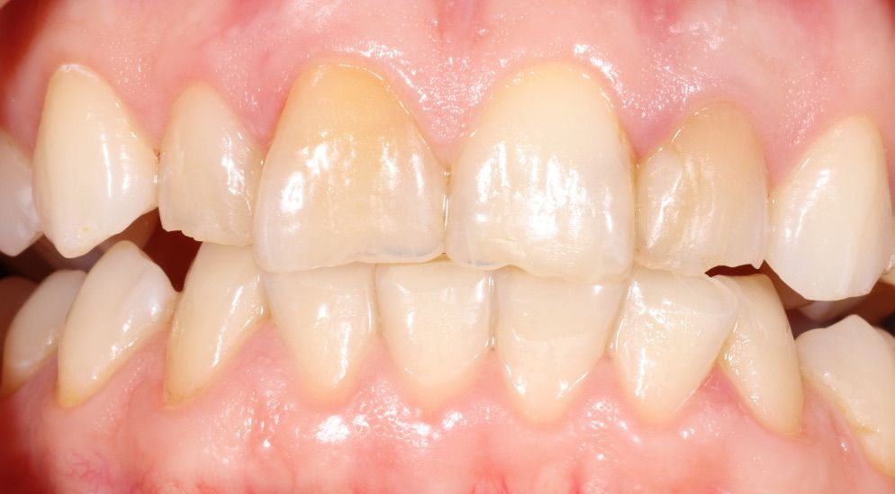 composite bonding smile gallery