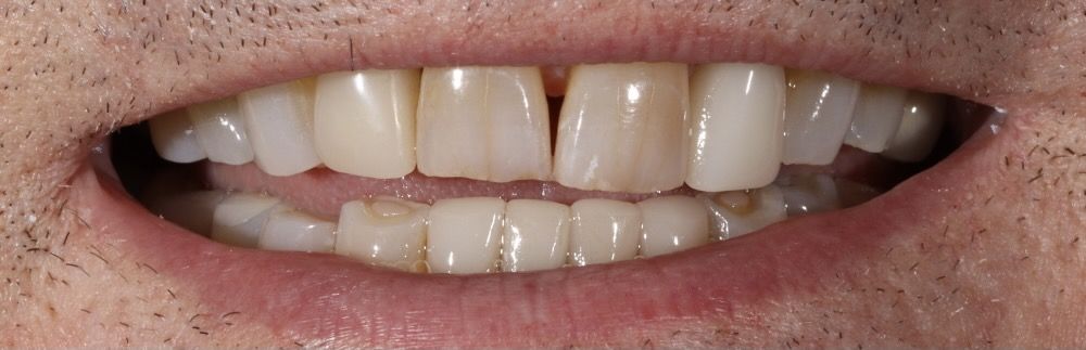 before dental veneer