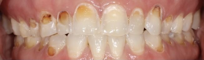 before dental veneer