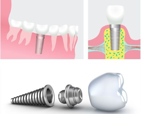 dental implant anatomy