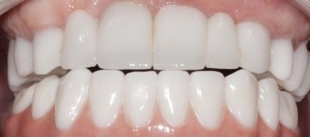 before composite bonding