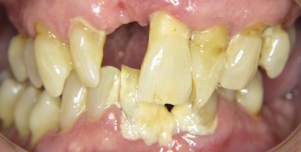 after composite bonding