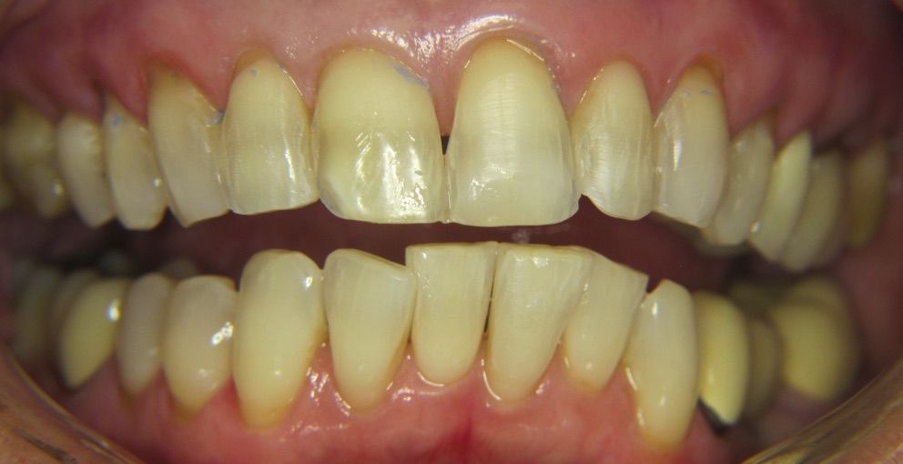 after composite bonding