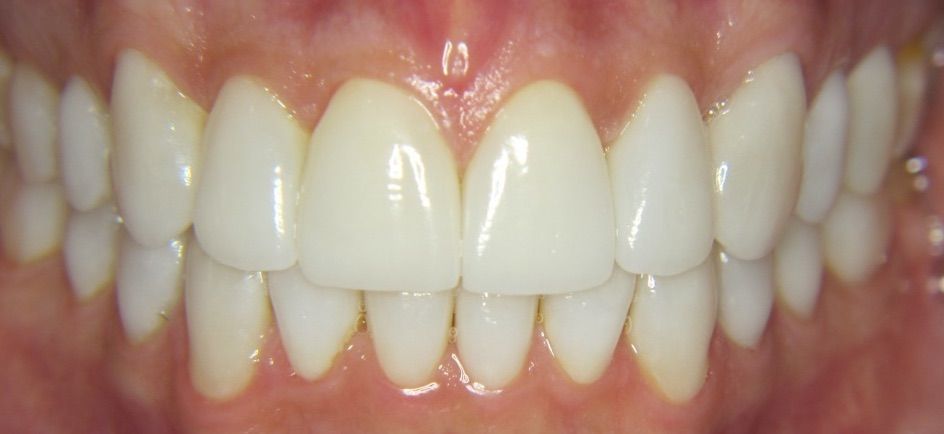 before composite bonding