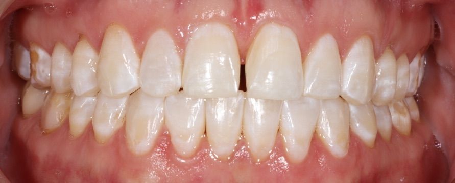 after composite bonding