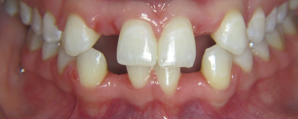 after composite bonding