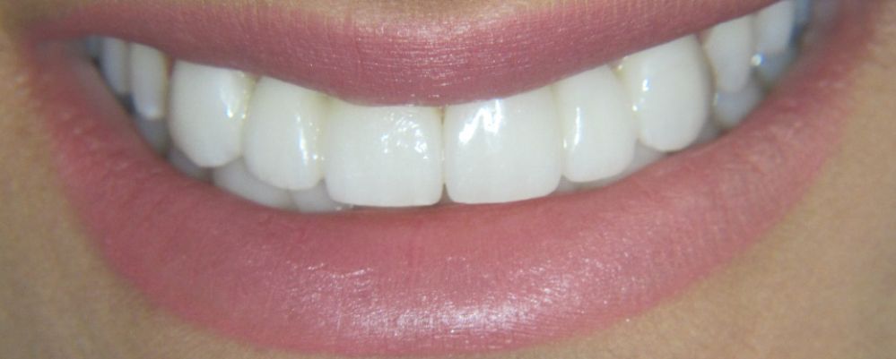 before composite bonding