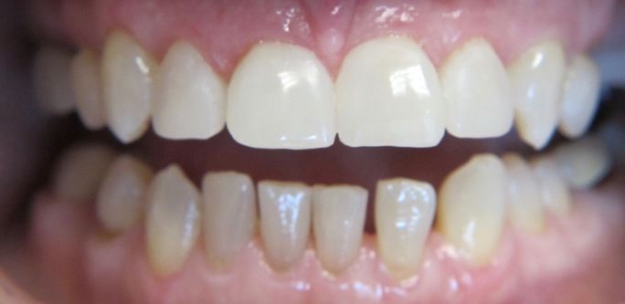 benefits of composite bonding