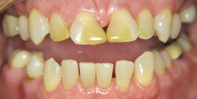 composite bonding smile gallery