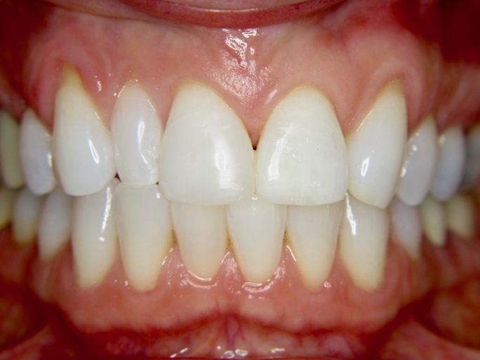 after dental veneer