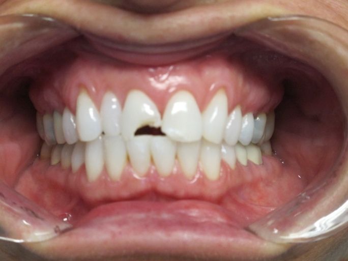 before dental veneer