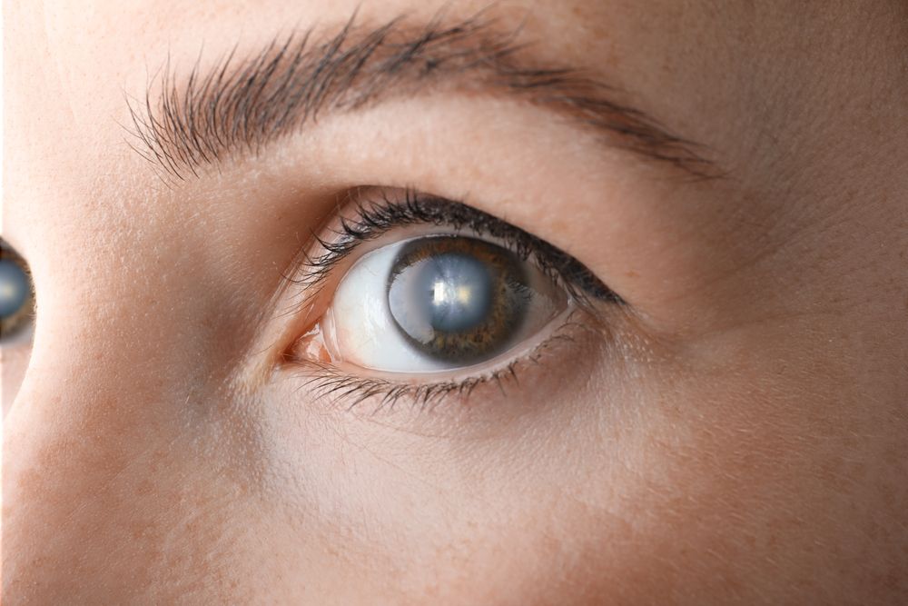 How Different Types of Cataracts Present Different Symptoms 