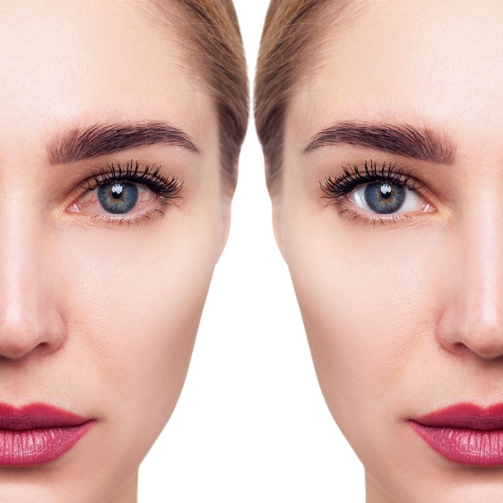 IPL vs. Radiofrequency: Decoding the Dynamic Duo of Tear Restoration