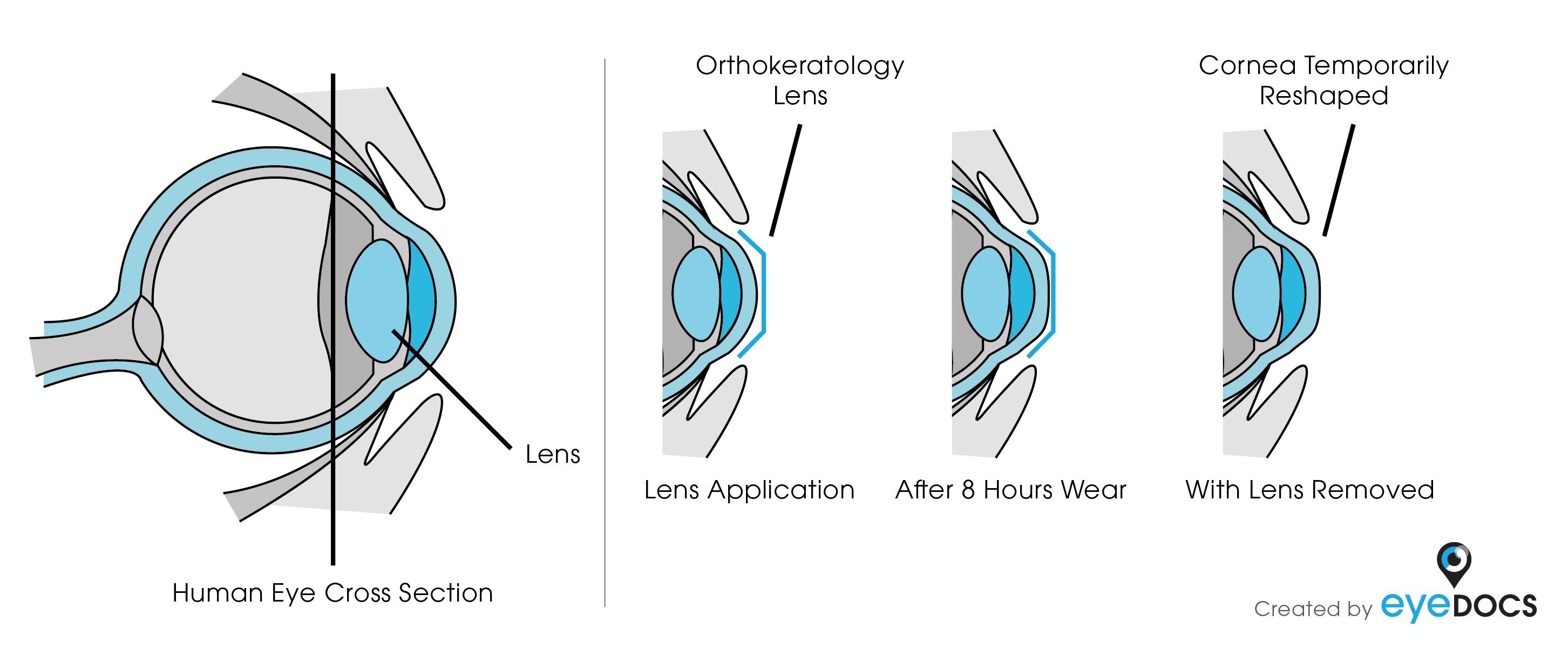 Cornea Illustration