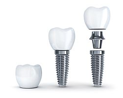 Example of dental implant