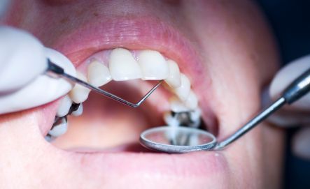Mouth with Cavities