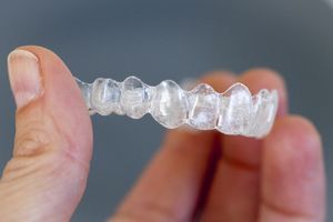 clear aligner