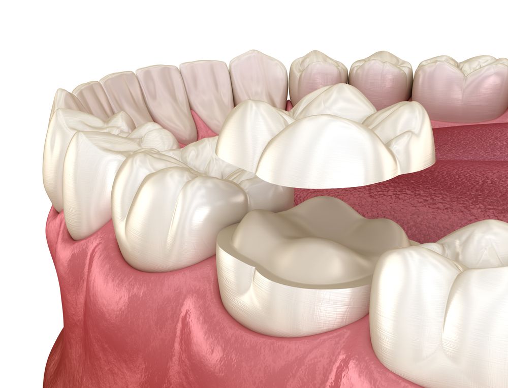 Exploring the Benefits of Dental Sealants