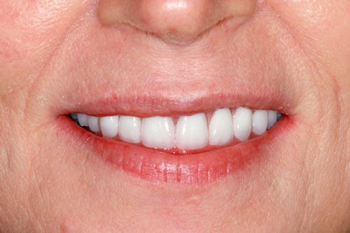 After smilemakeover