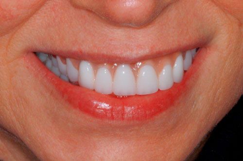 after dentures