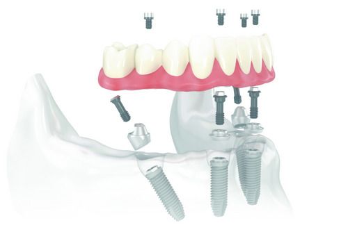 All on my 4 implant Provider