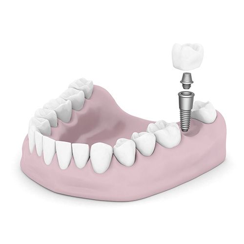 Dental implant in bottom of teeth