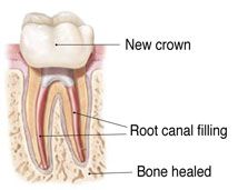 Root canal