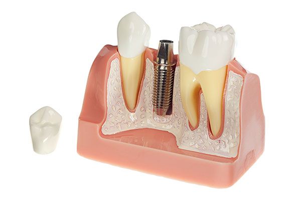 Implants