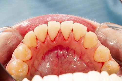 Teeth and irritated Gums