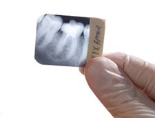 Digital X-rays