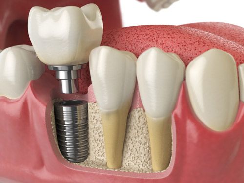 Implants Cross Section
