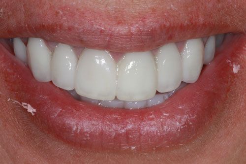 After dental crowns