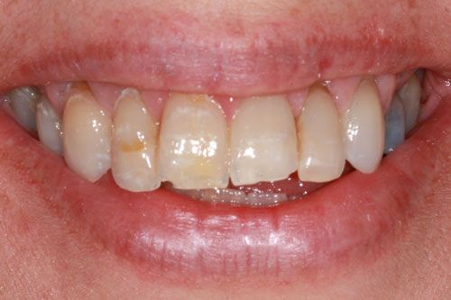 Before dental crowns