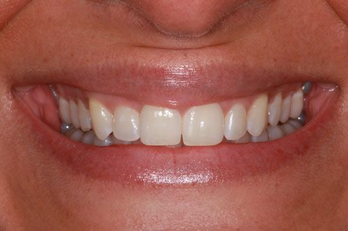 after braces
