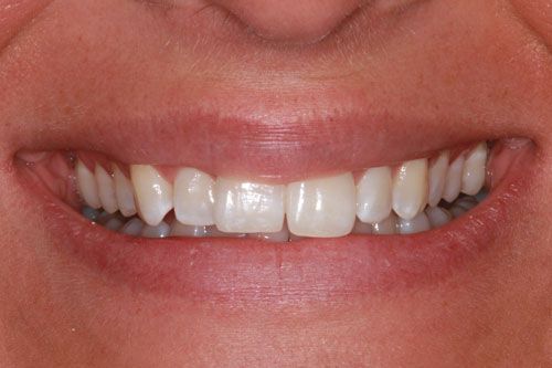 before braces