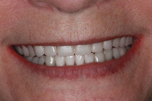 After dentures