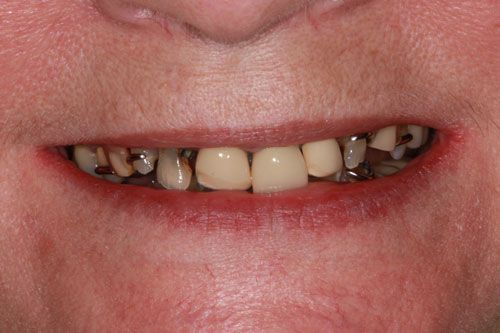 Before dental bridges