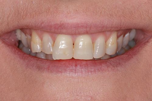 Before Veneers