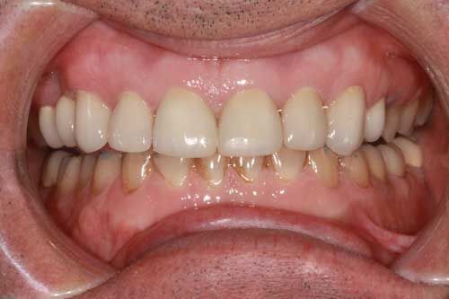 Restored smile after teeth grinding